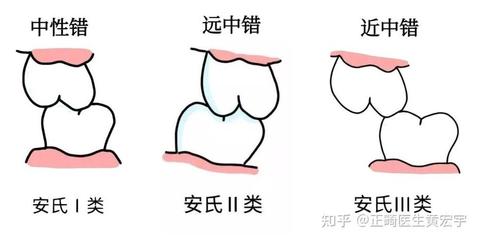 安氏Ⅱ類錯(cuò)HE畸形的圖解與臨床解析